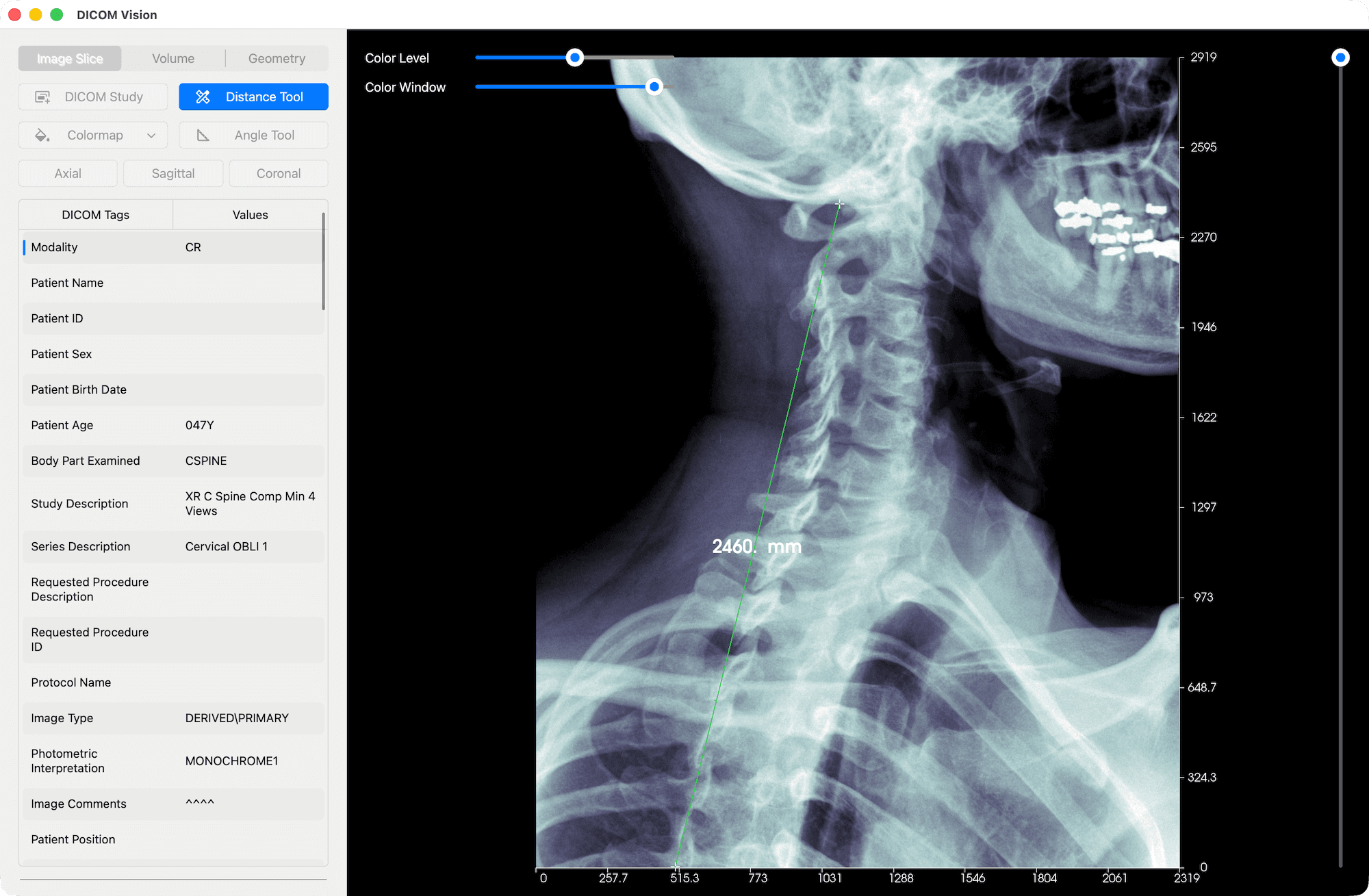 Measure Distance Tool - DICOM Vision